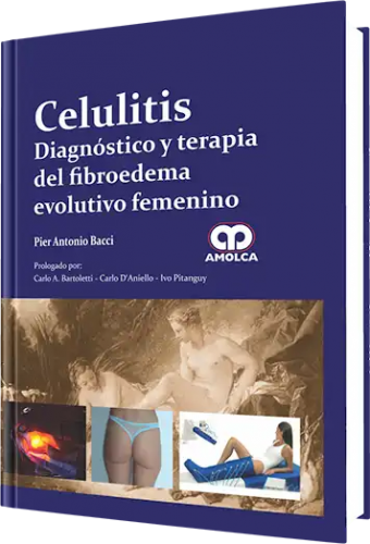 Celulitis Diagnóstico y Terapia del Fibroedema Evolutivo Femenino