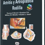 Artritis y Artroplastia Rodilla