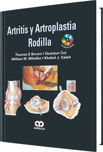 Artritis y Artroplastia Rodilla