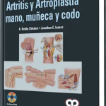 Artritis y Artrosplastia Mano, Muñeca y Codo
