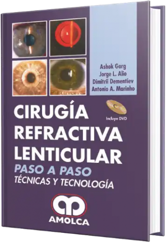 Cirugía Refractiva Lenticular.